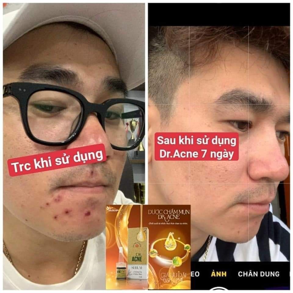[Freeship] Dược chấm mụn dr acne Hải Âu Việt