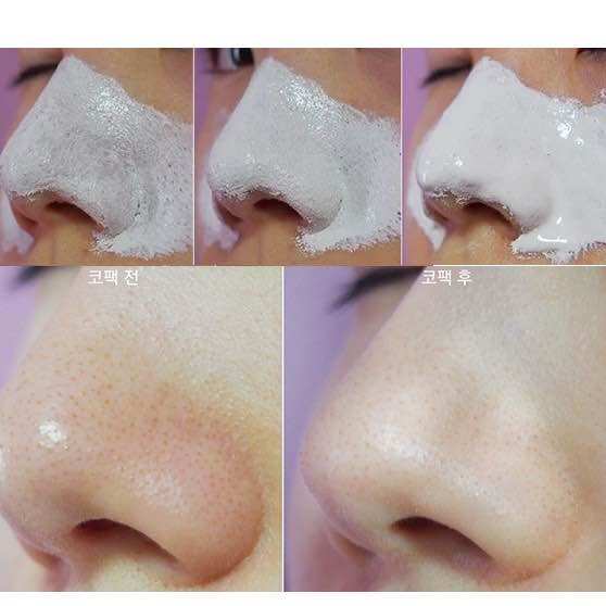 Gel lột mụn cám Peeling Pack