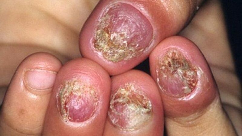 Dung Dịch Đánh Bay Nấm Móng _ Nấm Móng (1 chai )