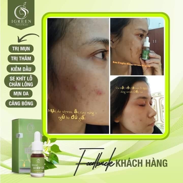 SERUM DIẾP CÁ GIẢM MỤN, THÂM, SE KHÍT LỖ CHÂN LÔNG - IGREEN