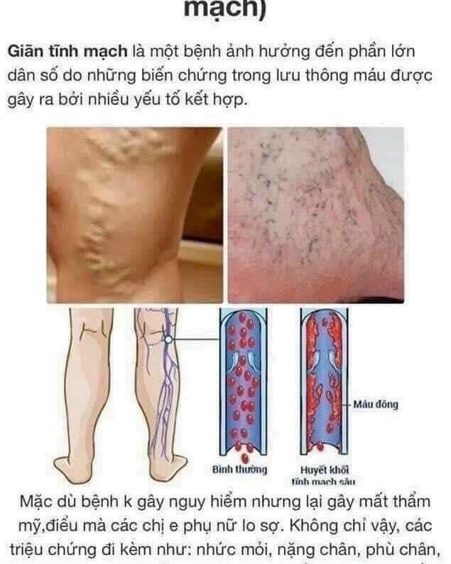 Kem bôi suy giãn tỉnh mạch chân Philosoft