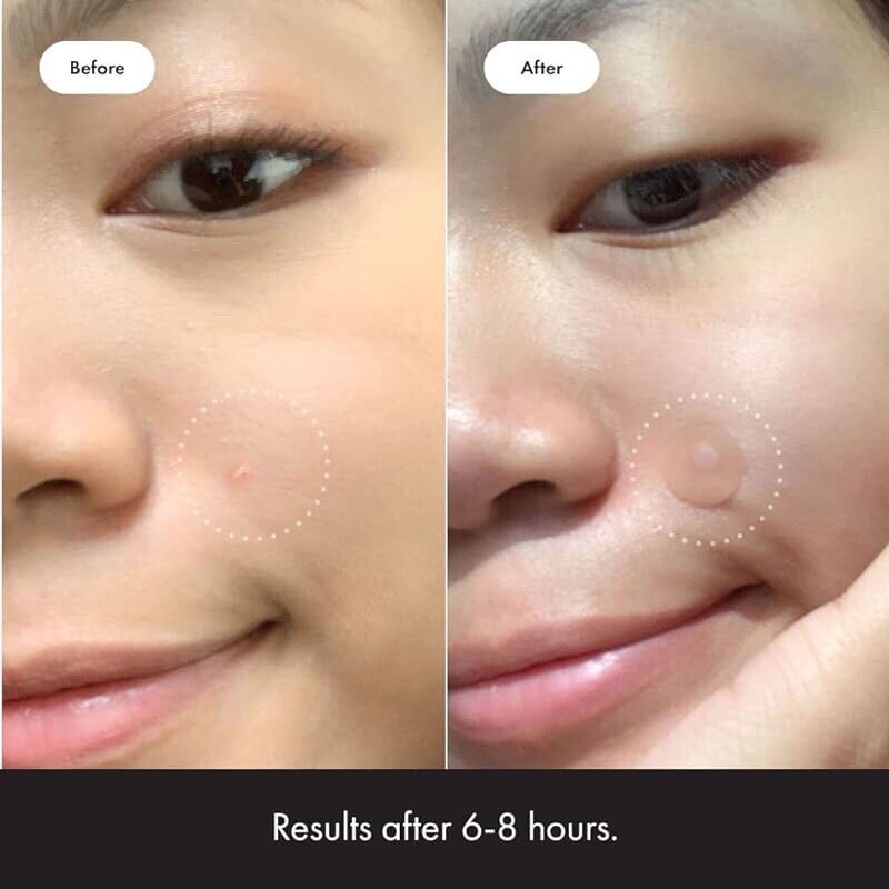 Miếng dán mụn Hero Cosmetics Mighty Patch (Original, Invisible, Variety, Micropoint for Blemishes, Dark Spots)