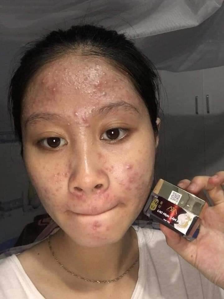 Cao sâm mụn chuyên mụn và thần thánh mụn