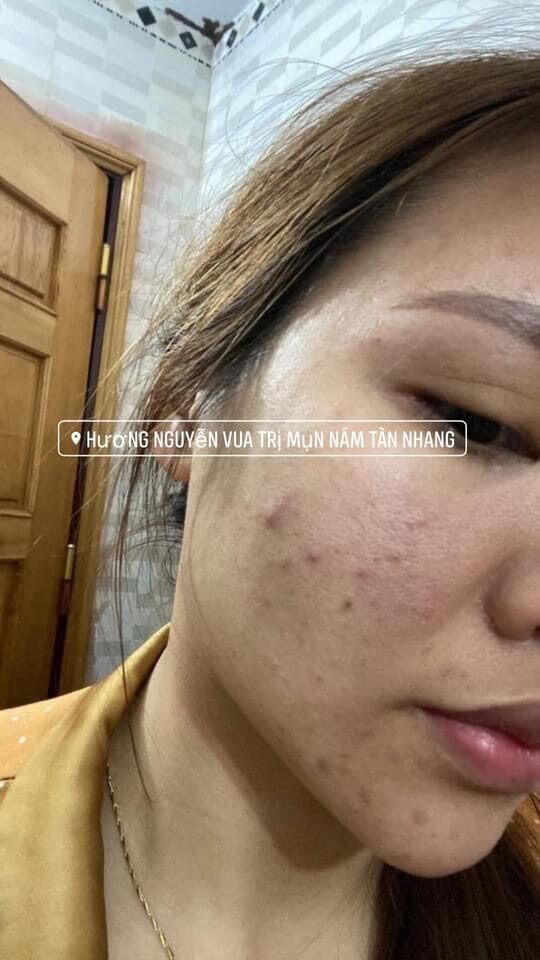 Serum Mộc Beauty Ngăn Ngừa Mụn Thâm