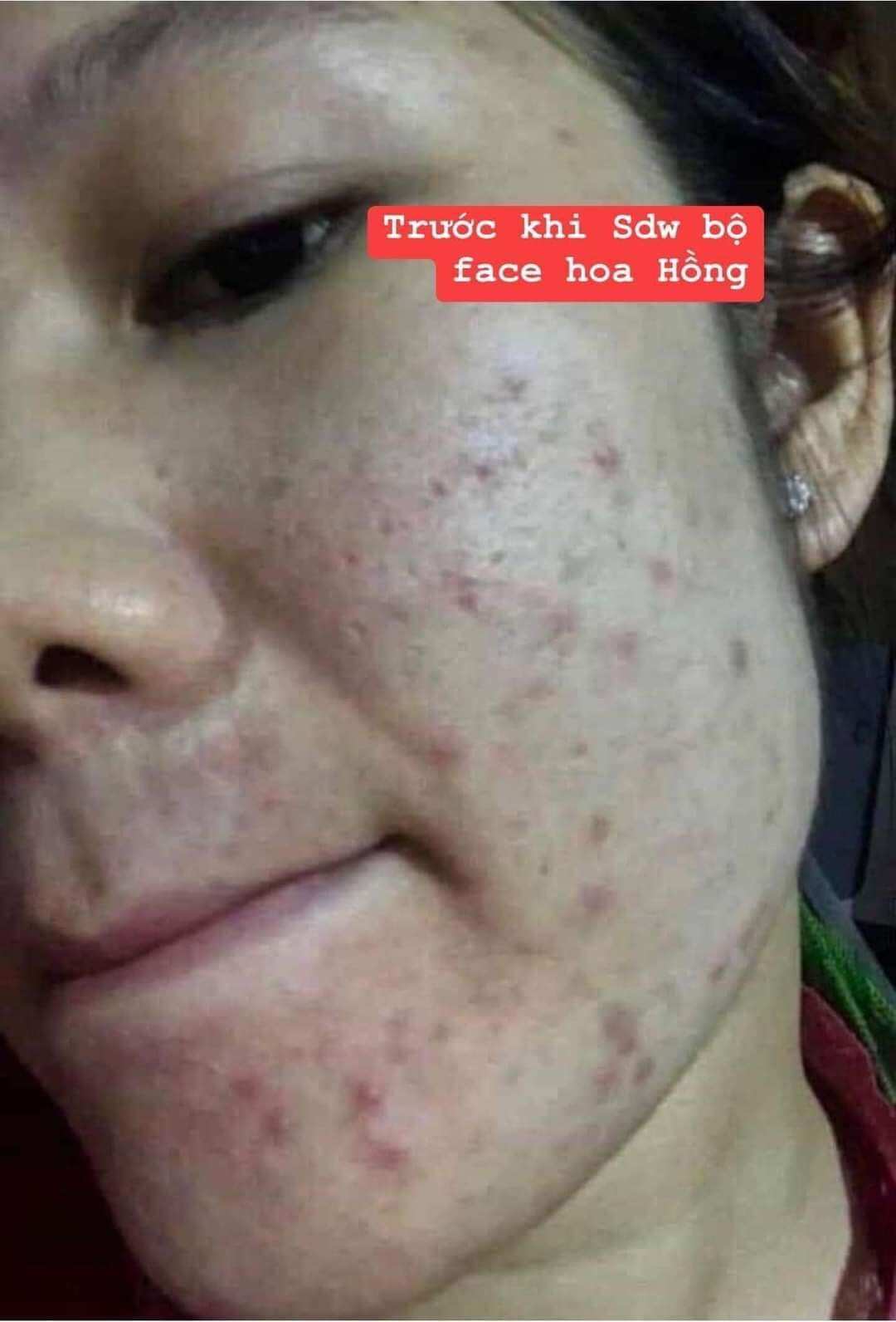 combo face hoa hồng ngọc nữ