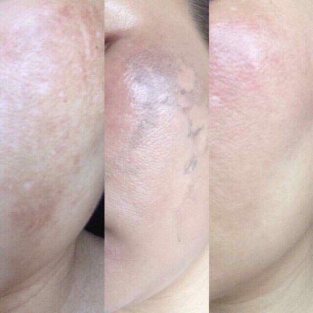 Vi kim tảo biển Ultra V(1 cặp)