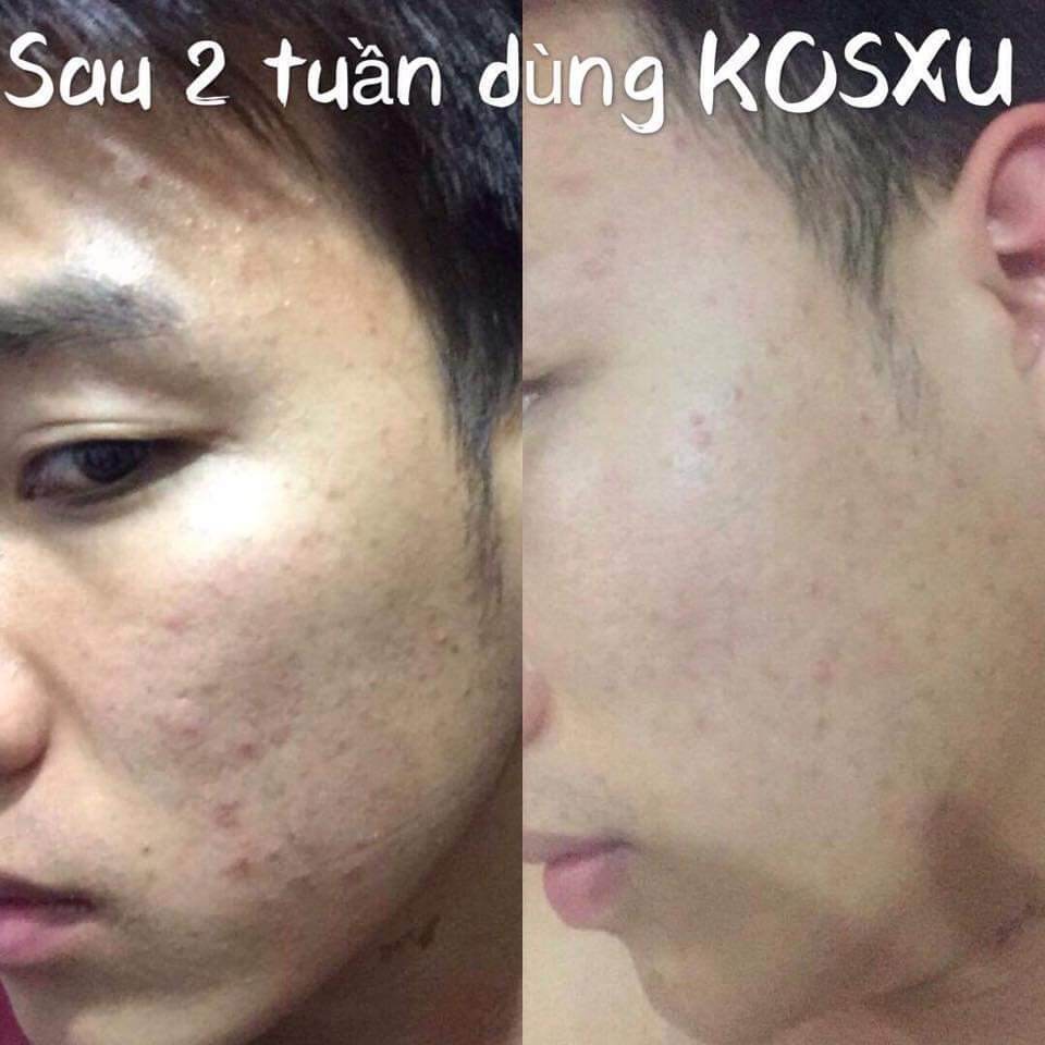 Serum ong Kosxu căng bóng thánh mụn ẩn