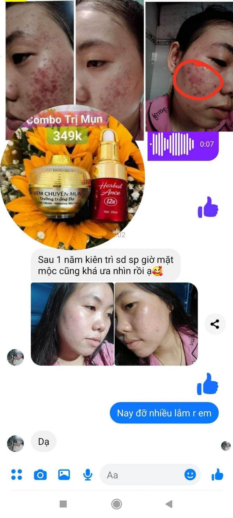 Serum chấm mụn 12h huỳnh đỗ