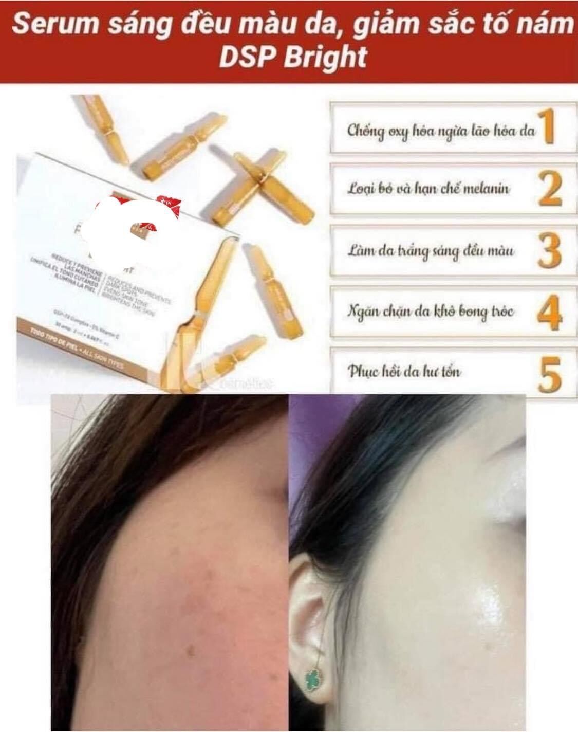 {Com bo 5 ống}SERUM DƯỠNG TRẮNG MỜ ĐỐM THÂM TÀN NHANG DSP MARTIDERM