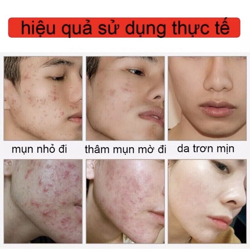 Kem ngừa mụn hiệu quả nhanh (đát luôn mới)