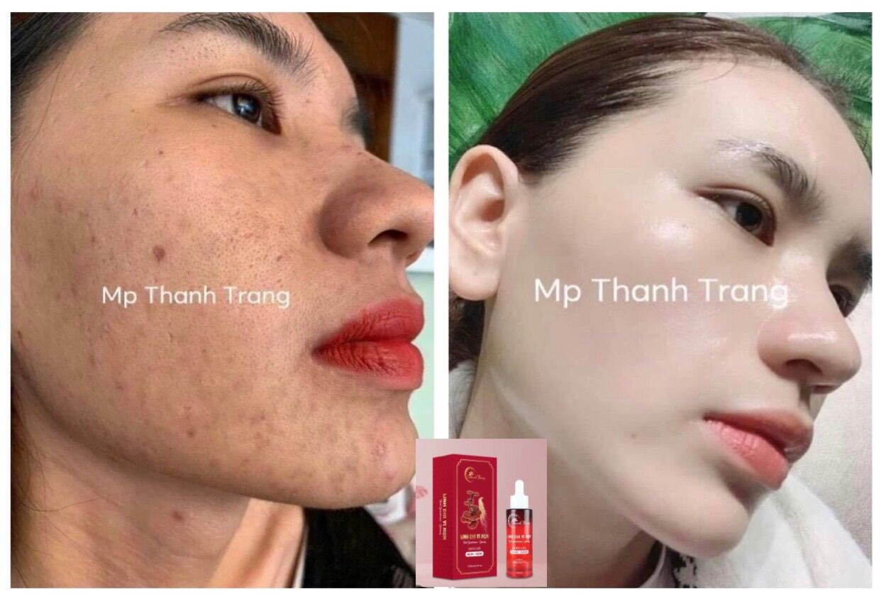 Combo Thảo dược hết mụn, thâm nám Thanh Trang