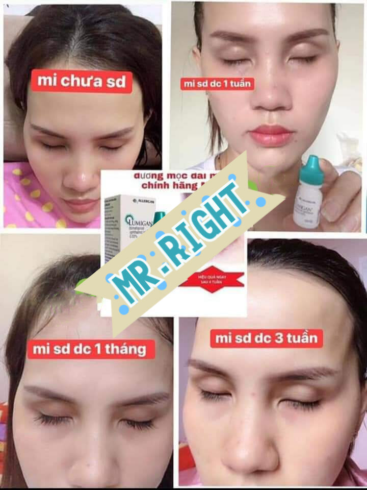 Tinh chất dưỡng mi Lumigan