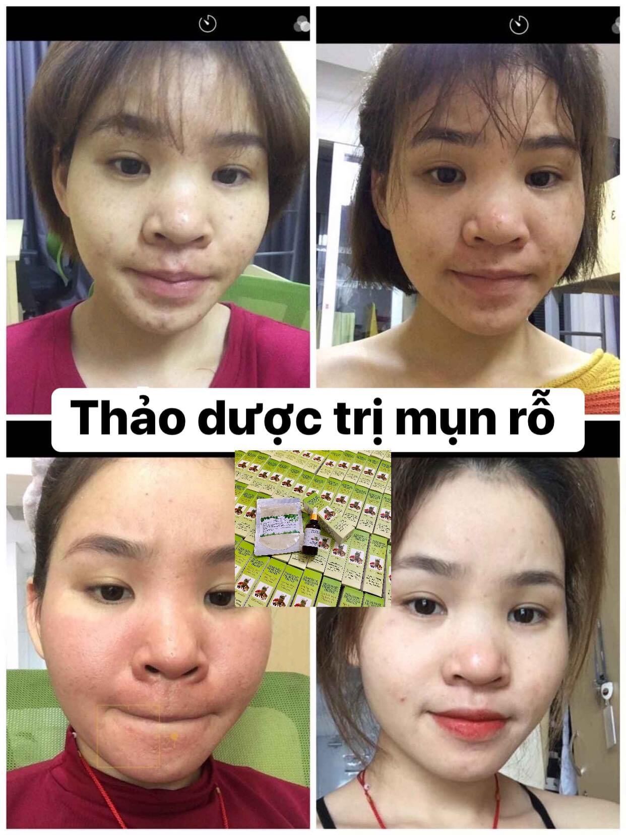 Compo Thảo Dược Sạch Mụn và Bột rửa mặt sạch dầu (50ml)
