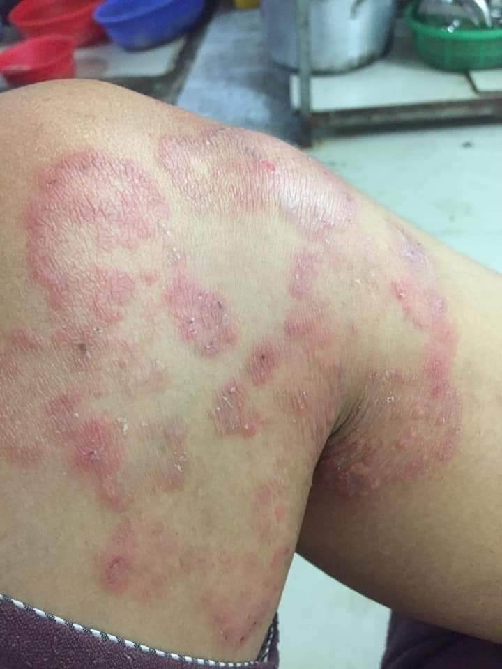 kem bôi da liễu , á sừng , nấm , ngứa nội địa trung chính hãng