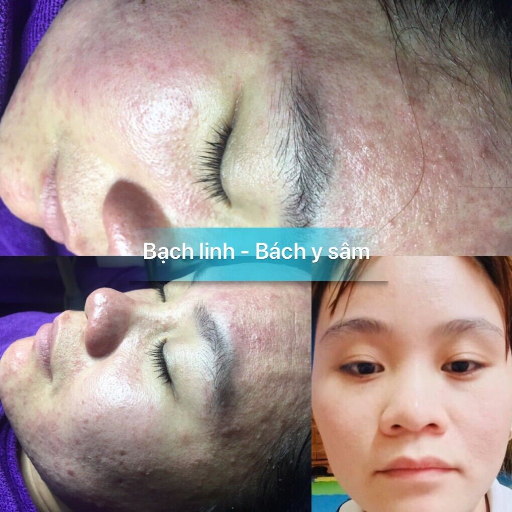 Combo cho da mụn Bách y sâm - bạch linh (tặng 1 hộp ngâm chân Bách thọ khang 195k)