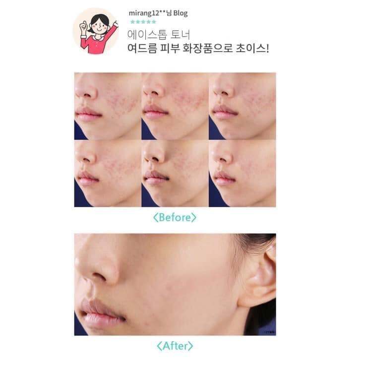 Huyết thanh thay đổi làn da mụn trong 5 ngày A.Stop Clear Serum (Hàn)