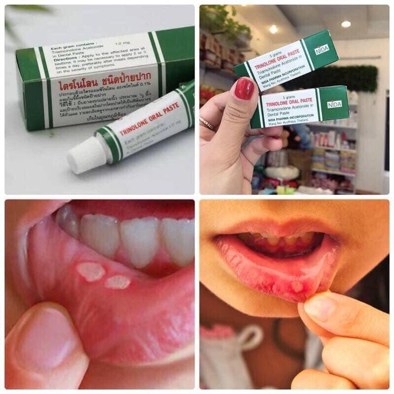 Kem bôi nhiệt miệng trinolone oral paste thái lan 5gr