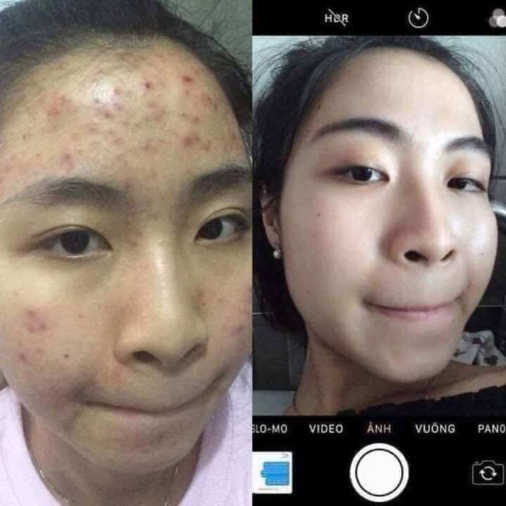 kem face chuyên mụn Huỳnh Đỗ