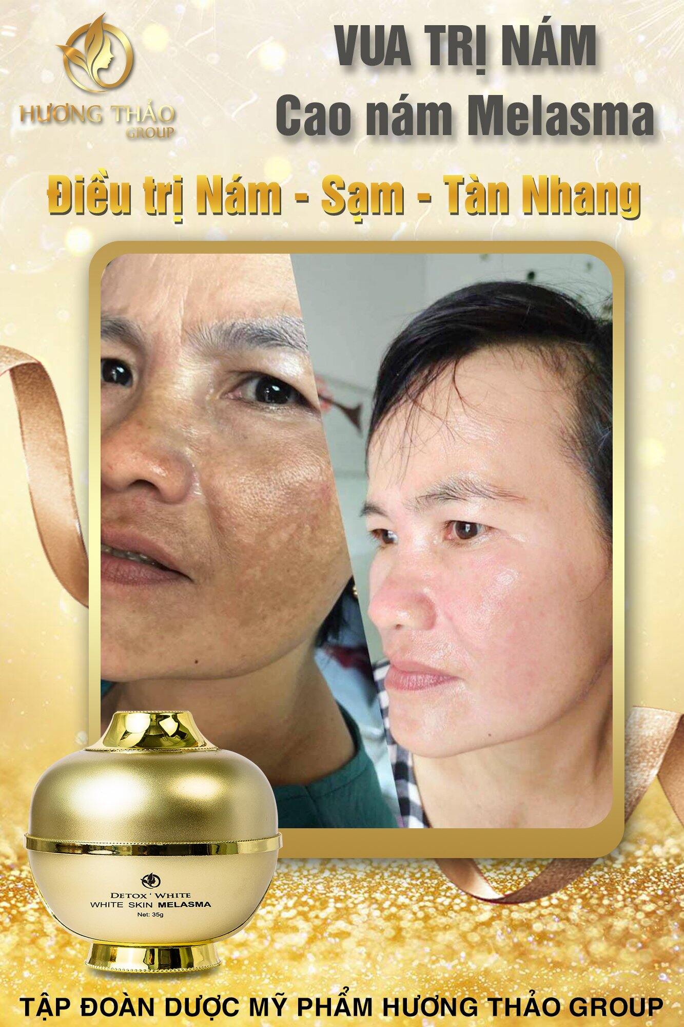 CAO NÁM MELASMA