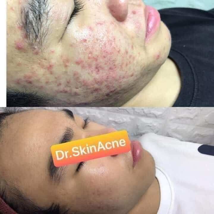 Kem Mụn Dr Skin sạch mụn - xóa thâm