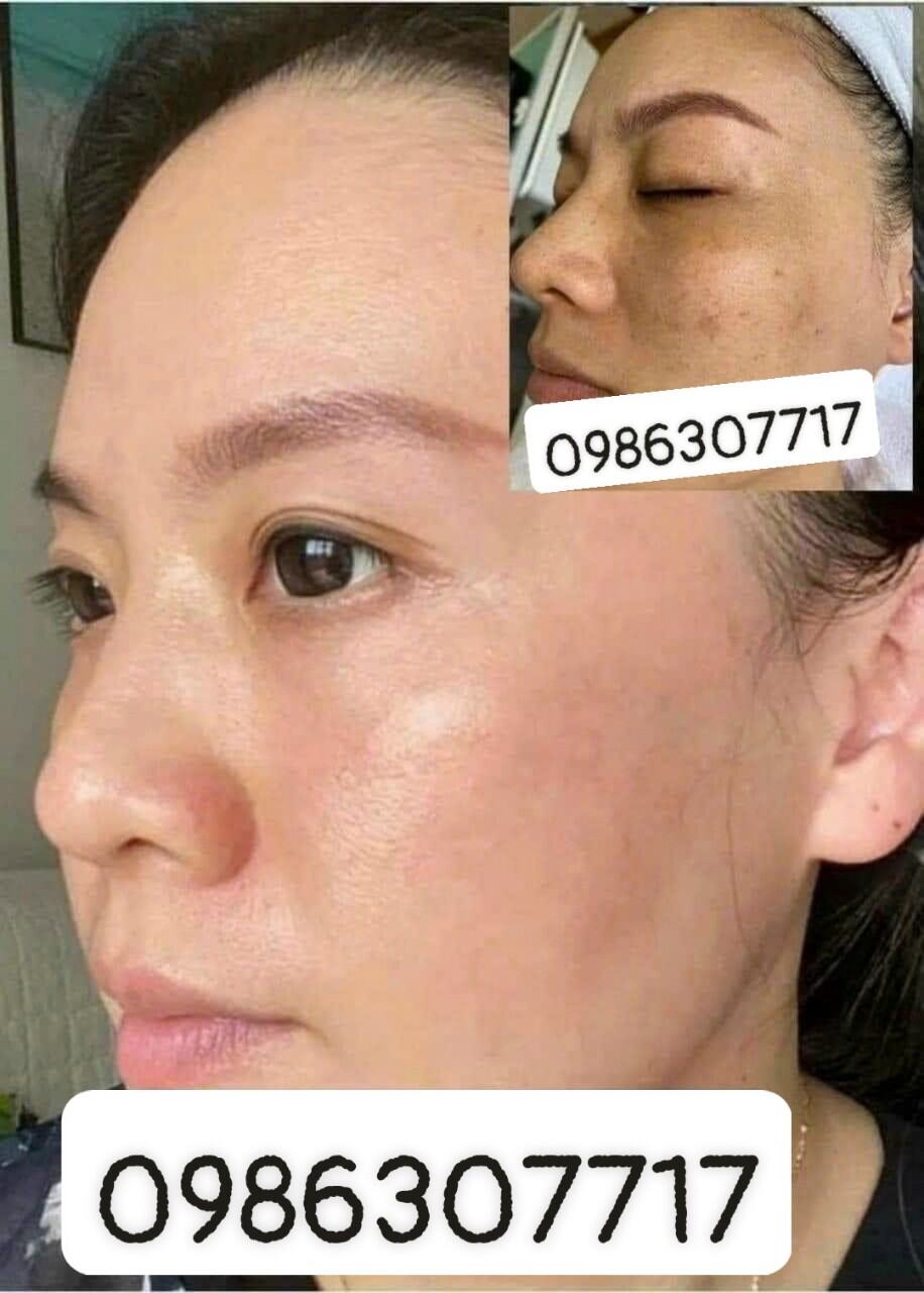 BỘ MỸ PHẨM Doctor Skin DNA MH 

🔥🔥 Bộ Kem trị nám tàn nhang dưỡng trắng da được rất nhiều chị em yêu thích và tin dùng đây là sản phẩm được bán rộng rãi ở khắp các nước Châu Á. 👉👉 Đặc biệt ở Việt Nam, Bộ mỹ phẩm DOCTOR SKIN DNA  650k