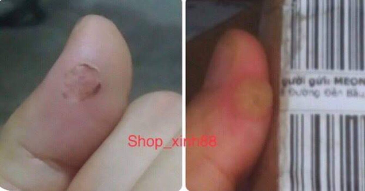 [ Loại Tốt ] Tẩy nốt ruồi , mụn cóc , mụn thịt, tàn nhang, mắt cá, handmade .