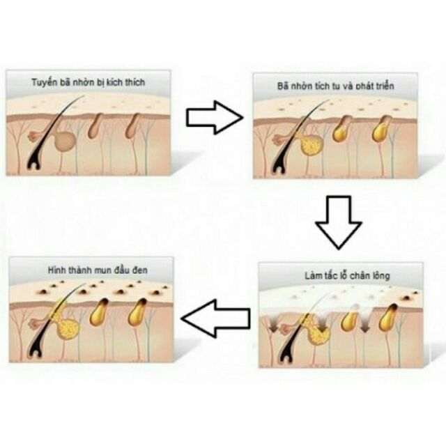 Máy hút mụn cầm tay sử dụng pin