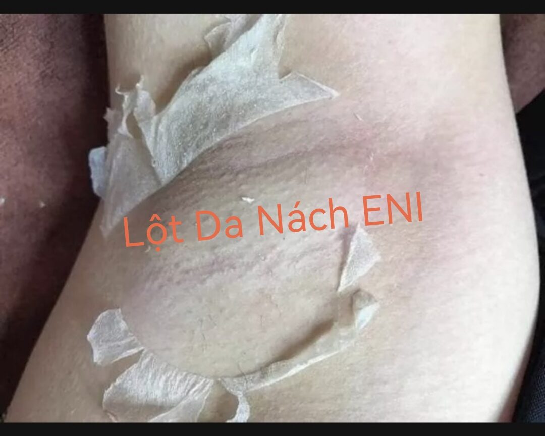 Lột trắng da nách mờ thâm eni