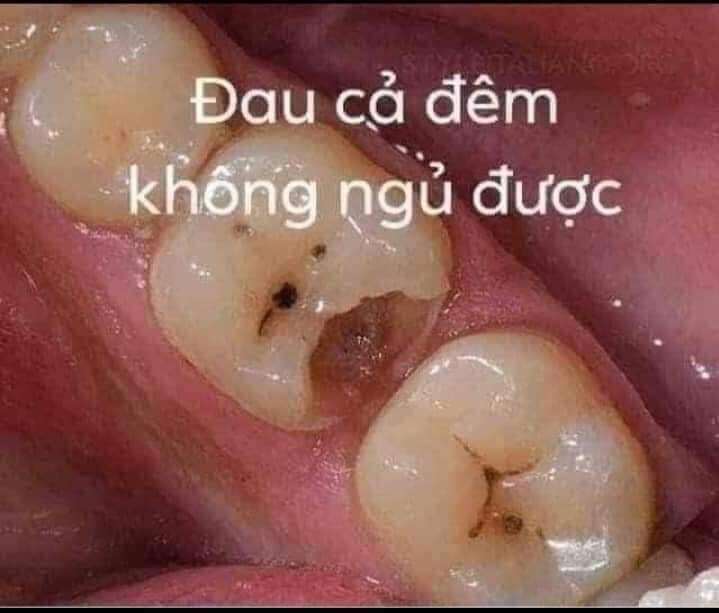 combo 2 lọ khoi hoàn toàn sâu răng