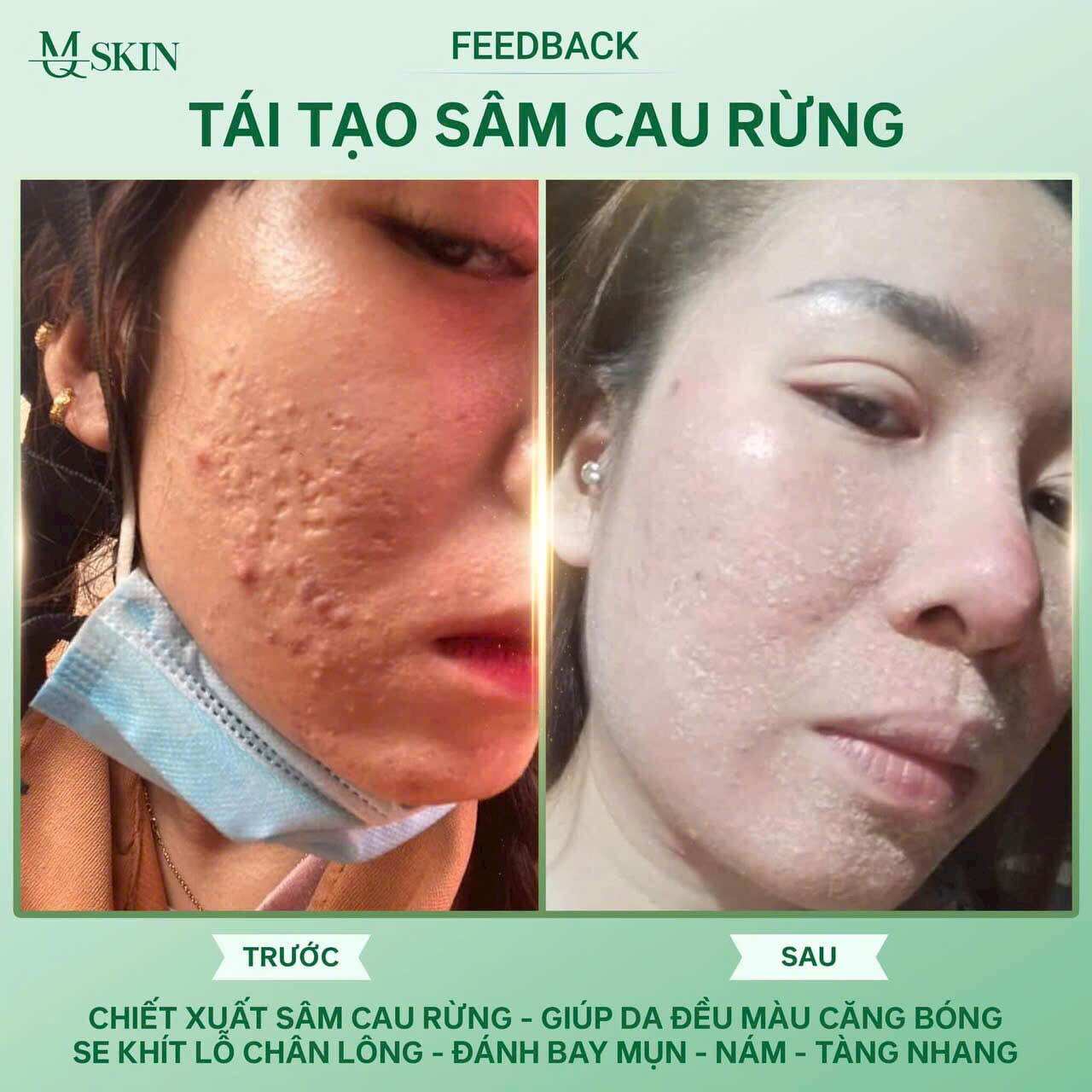 Combo Tái tạo sâm cau rừng( liệu trình 3 món)