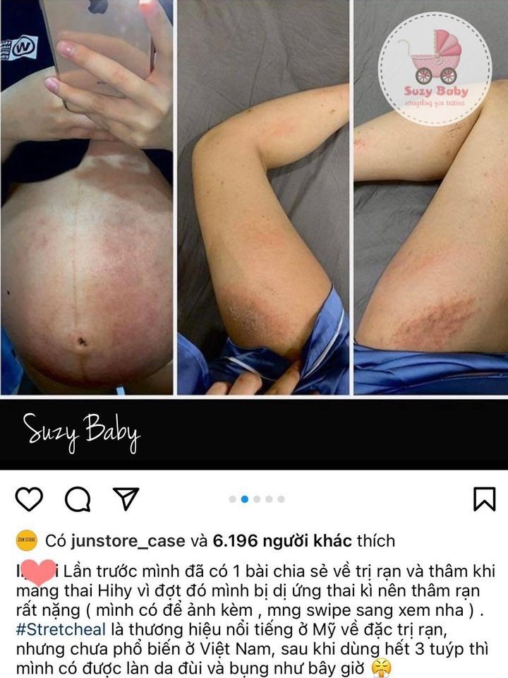 KEM BÔI TRỊ RẠN DA STRECT HEAL
