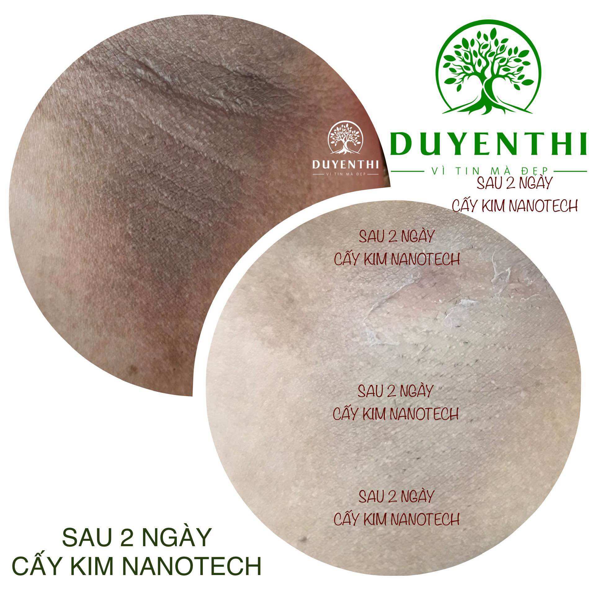 Bộ cấy kim nanotech Duyên Thị- Bách y sâm