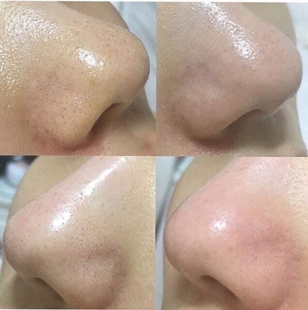 DUNG DỊCH Ủ MỤN ĐẦU ĐEN ME.DI.PELL