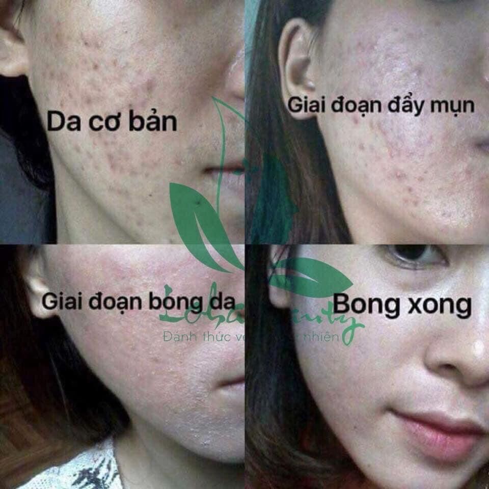 Tinh chất tái tạo da loha beauty (100ml tặng toner)