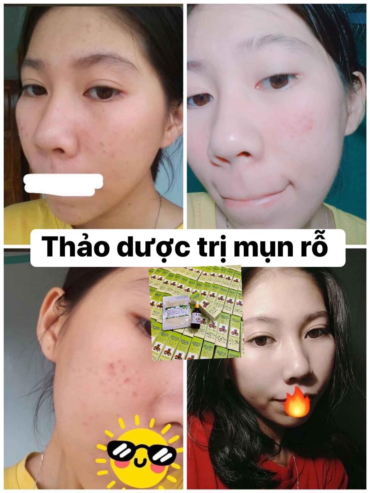 Compo 2 Lọ Thảo Dược Sạch Mụn MT (50ml)