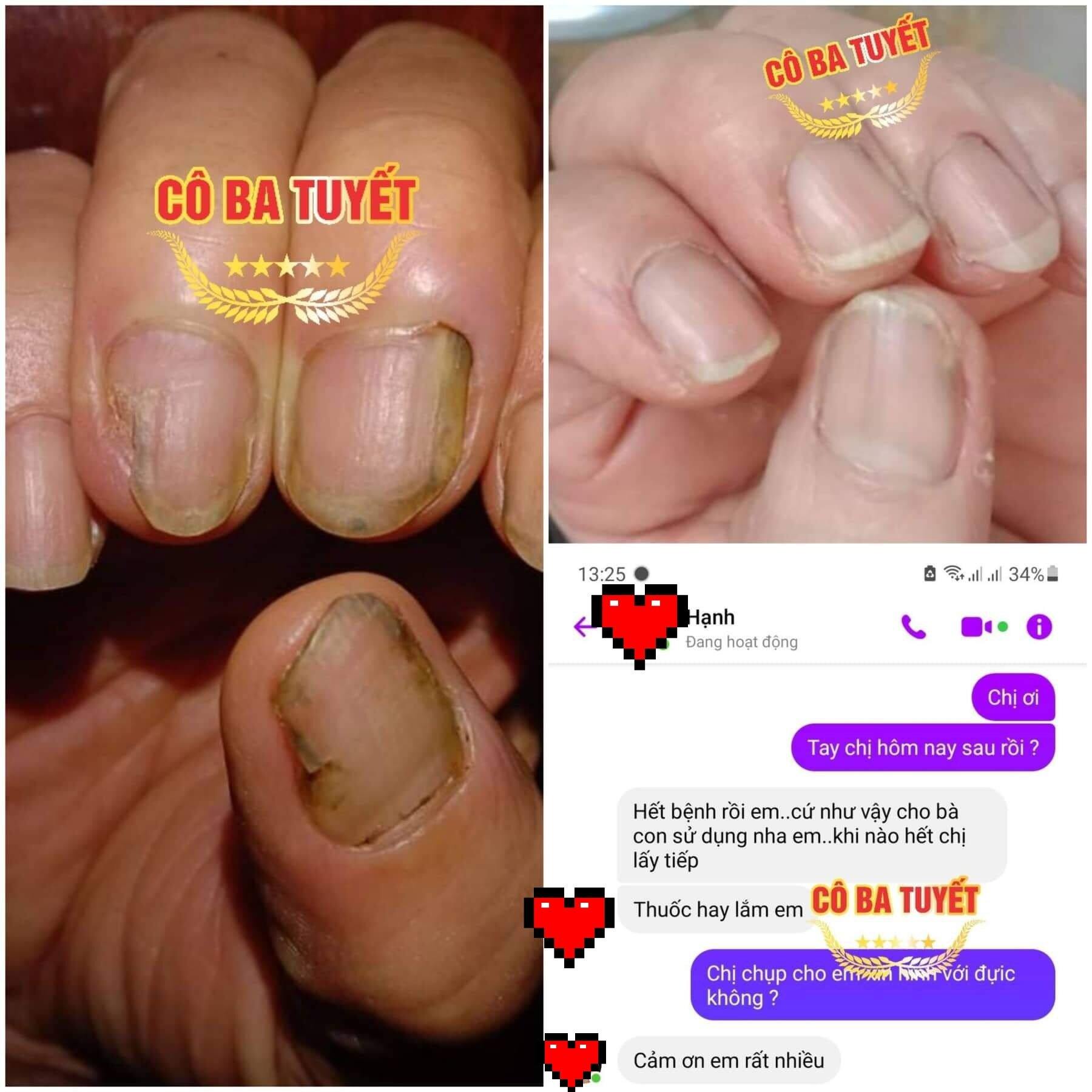 Nâm Móng Tay Chân , Dưỡng Móng