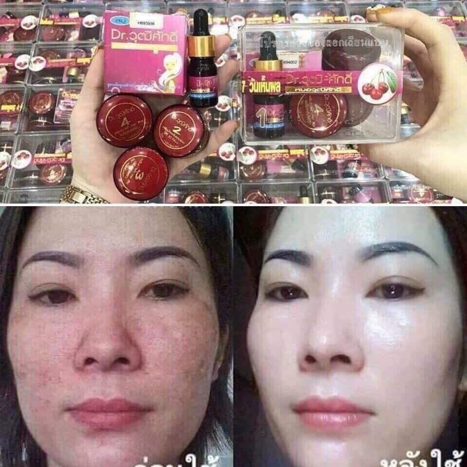 Bộ kem nám 5 sản phẩm cherry đỏ Thái Lan [SIÊU THỊ SV]