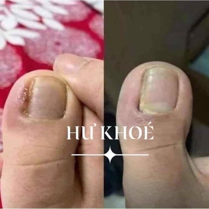 Dung Dịch Đánh Bay Nấm Móng _ Nấm Móng (1 chai )
