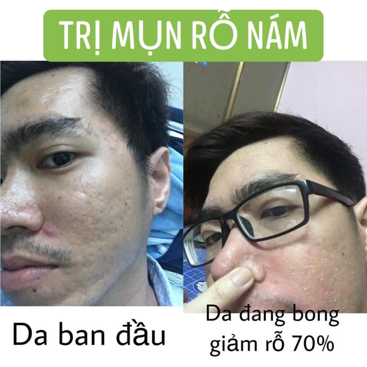 combo sạch mụn thâm rỗ 8 tuần(LO 100ML+ BOT KIEM DAU)