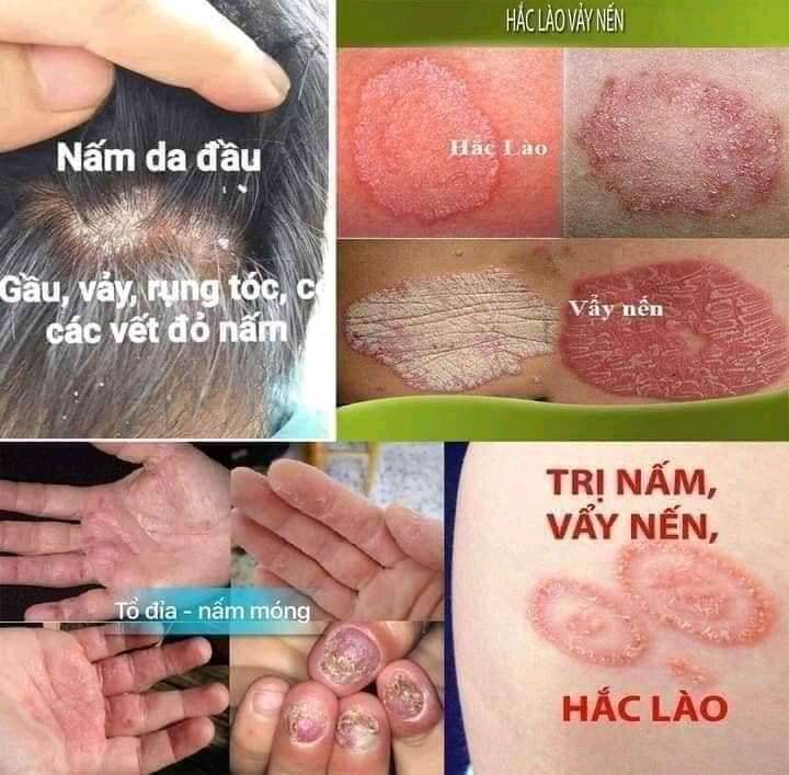 Nấm ngứa ngoài da