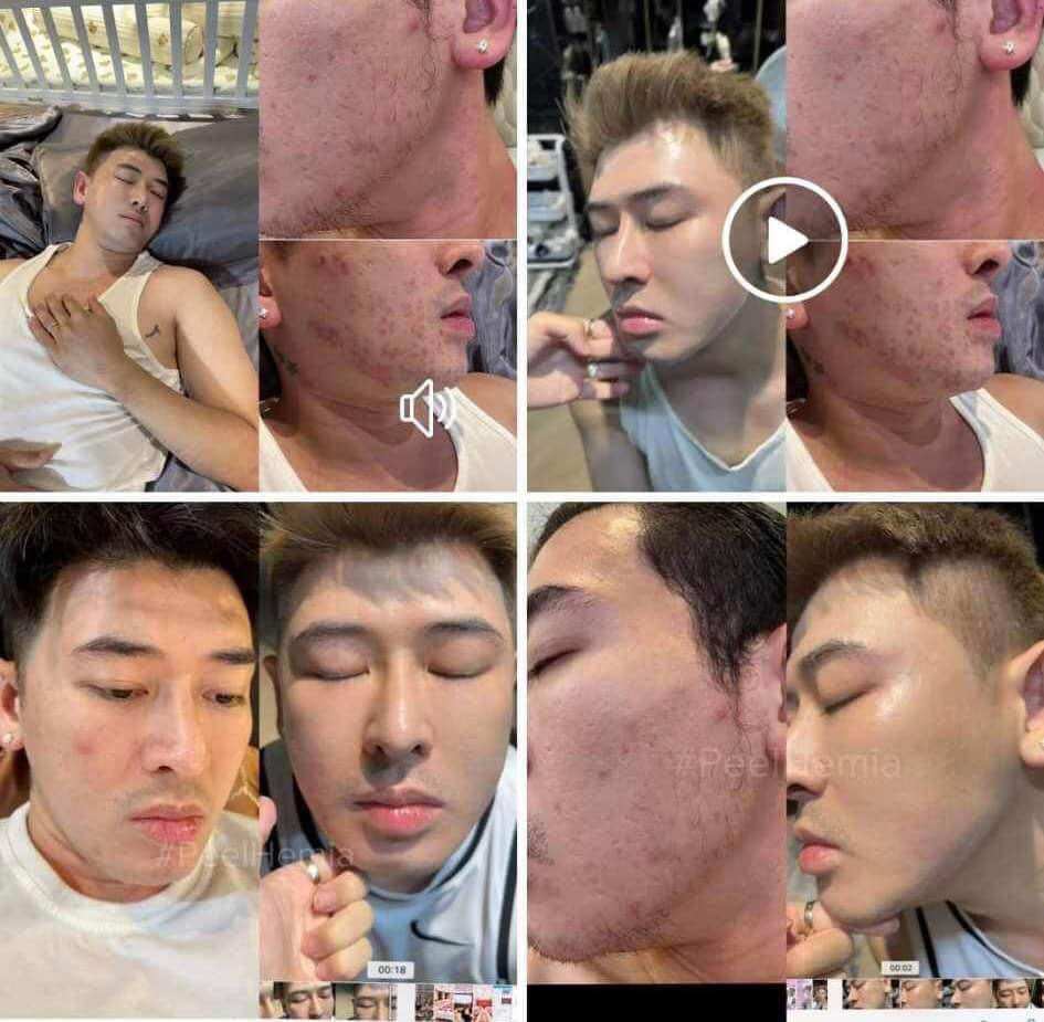 [Peel Da Hemia Hàn Quốc Căng bóng ]