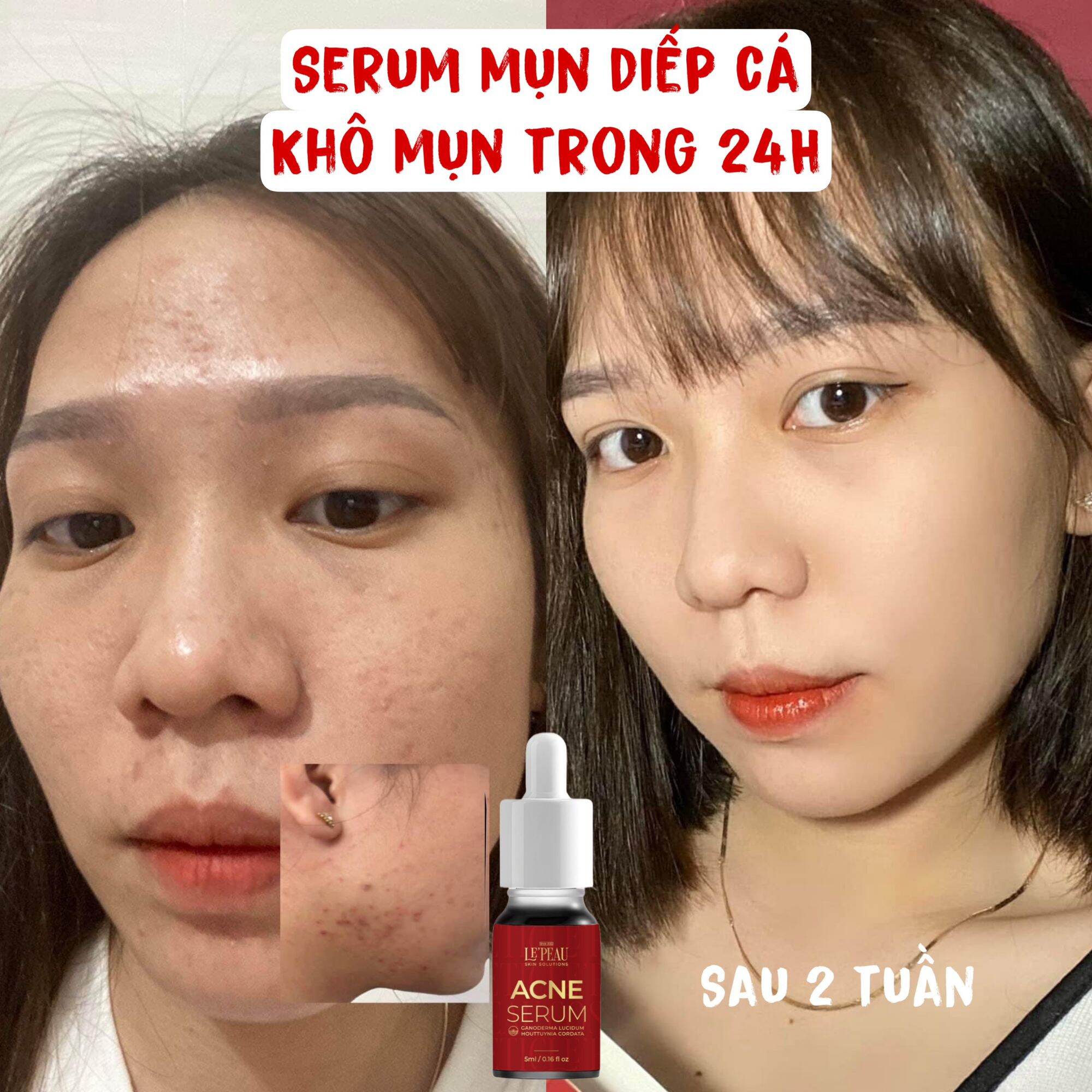 Chấm mụn Acne Serum Diếp cá (5ml) _Hoangthiensamshop