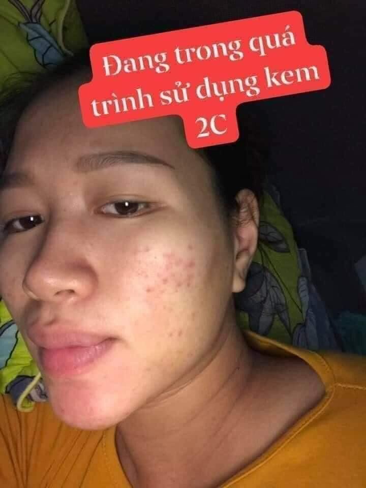 Kem mụn 2c giúp đánh bay mụn nám tàn nhang