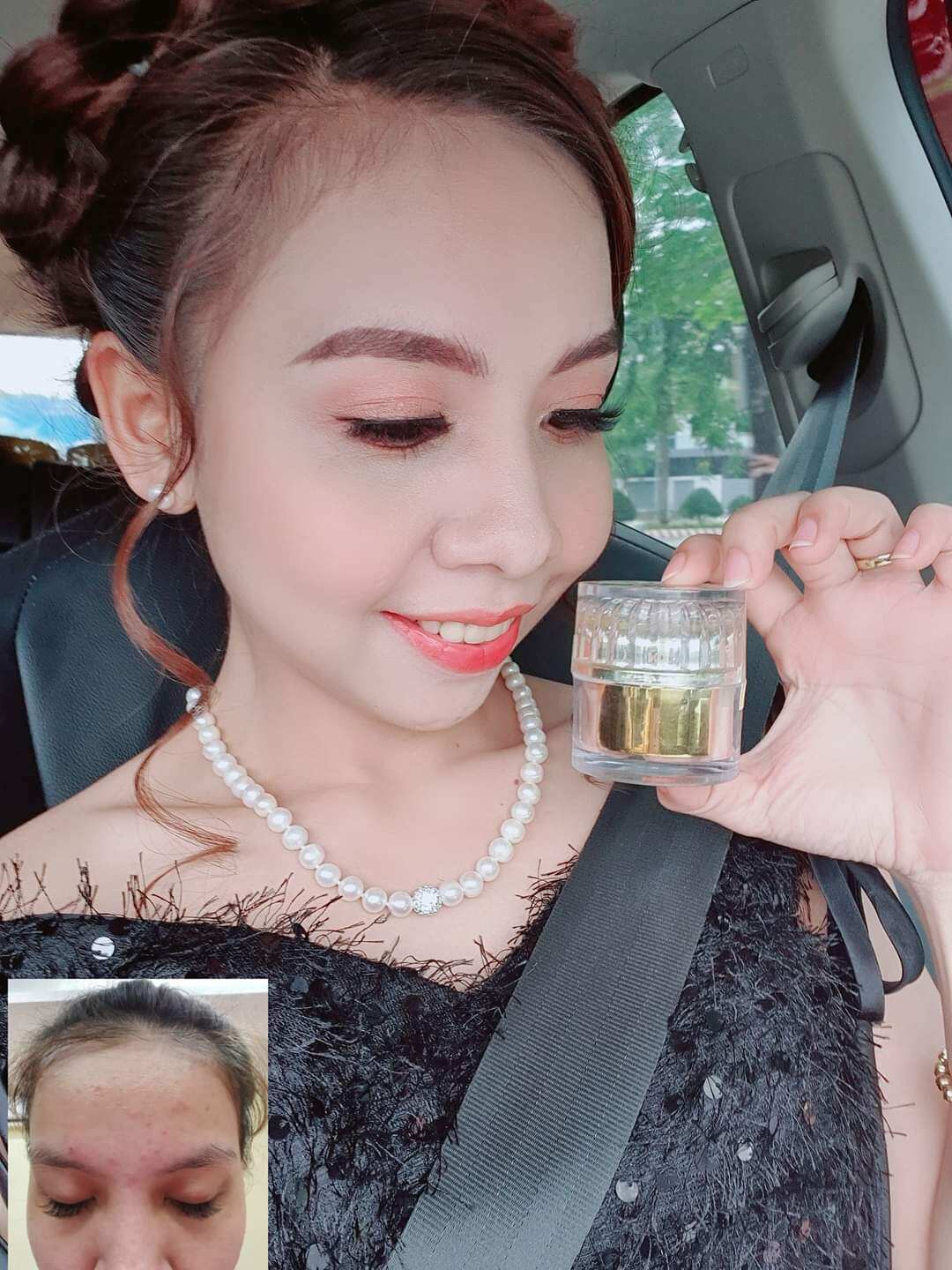 Kem trắng da ngừa mụn nám
