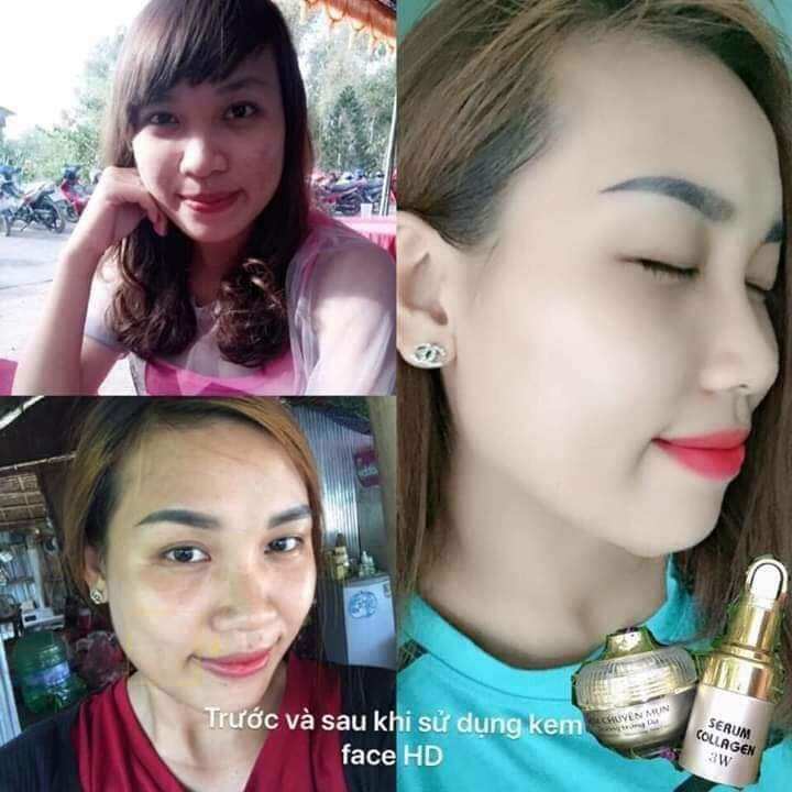 kem chuyên mụn huỳnh đỗ