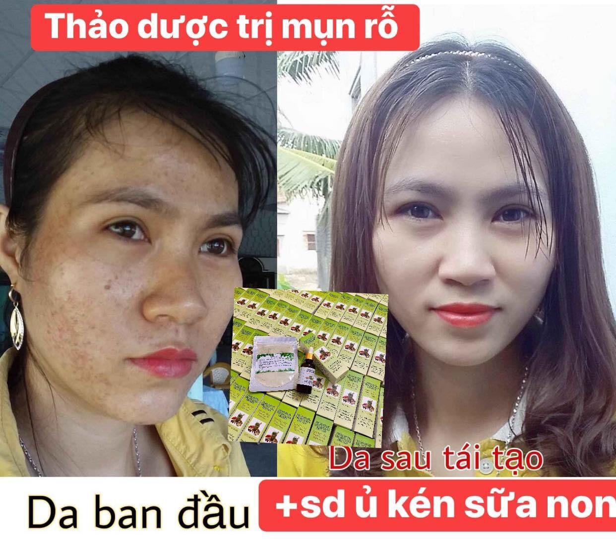 Compo Thảo Dược Sạch Mụn Và Bột Rửa Mặt Sạch Dầu