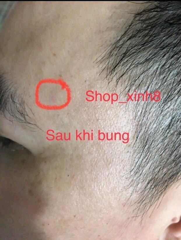 Tẩy xoá nốt ruồi ,mụn cóc,mụn thịt,tàn nhang