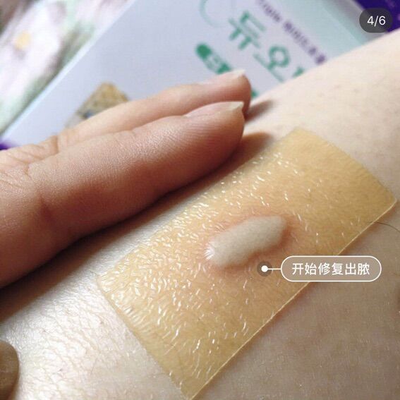 (1 miếng 10x10cm) Miếng dán mụn và vết thương hydrocolloid DuoDerm Extra Thin 10*10cm