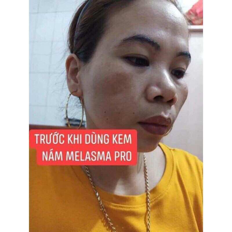 KEM NÁM PRO MELASMA TRẦN KIM HUYỀN