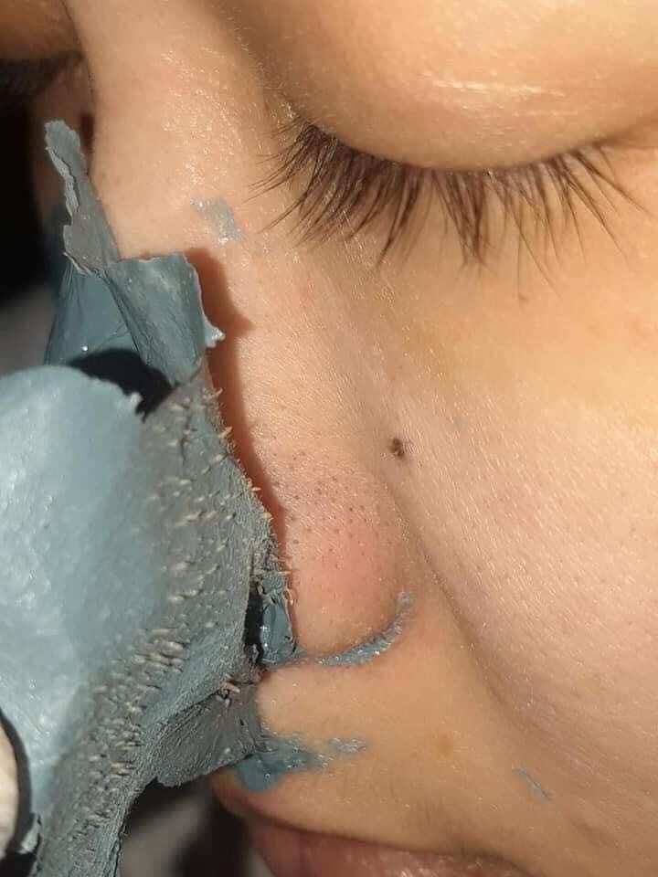 Gel lột mụn acnes chính hãng